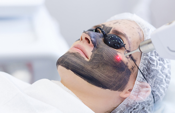 carbon skin rejuvenation laser facial