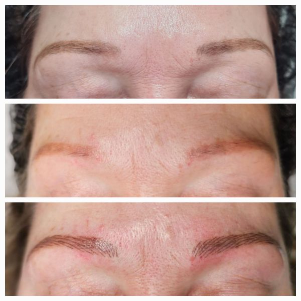 botched ink removal and new brow refresh exeter