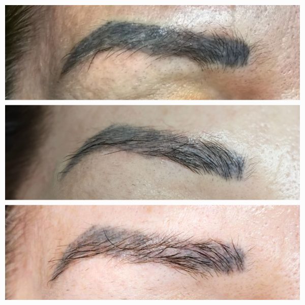 botched ink removal specialist devon