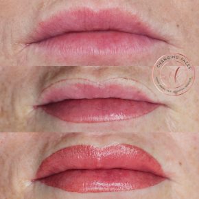 correcting asymmetry with lip blush