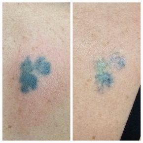 coloured laser tattoo removal