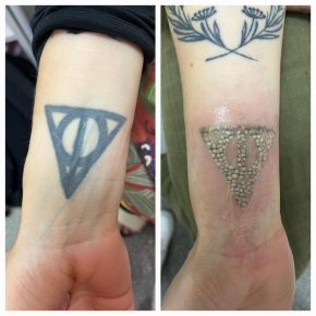 body tattoo removal exeter