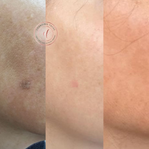 laser pigmentation removal devon