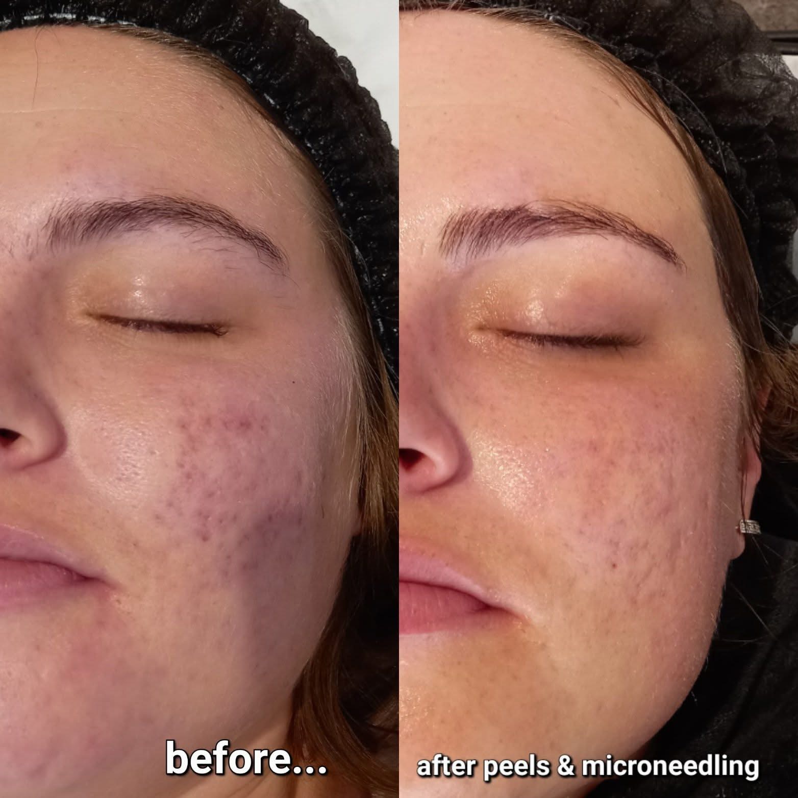 microneedling and peel treatments (1)