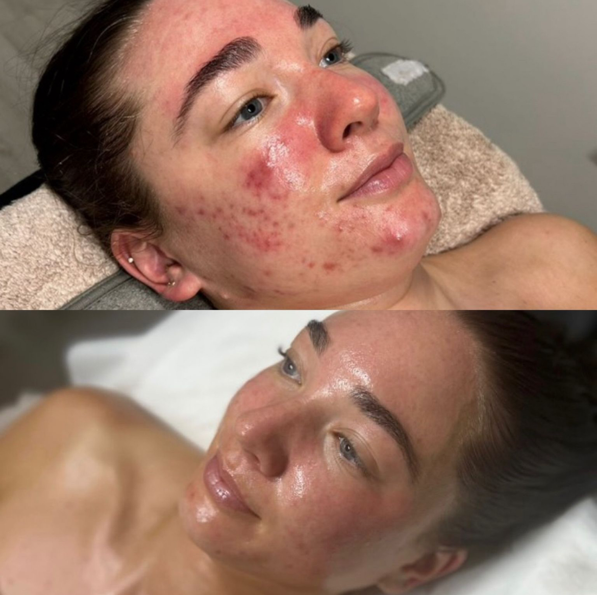 microneedling and peels