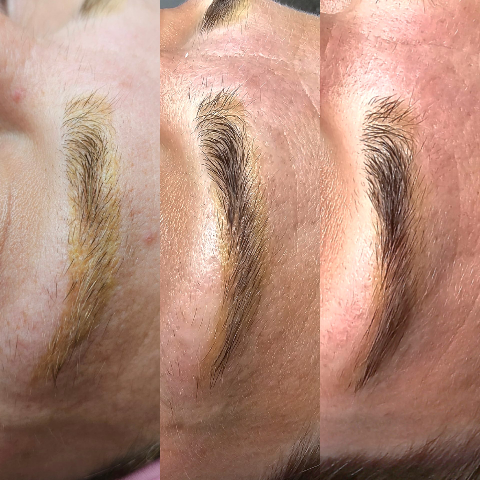 3 images showing PMU botched ink before and during removal