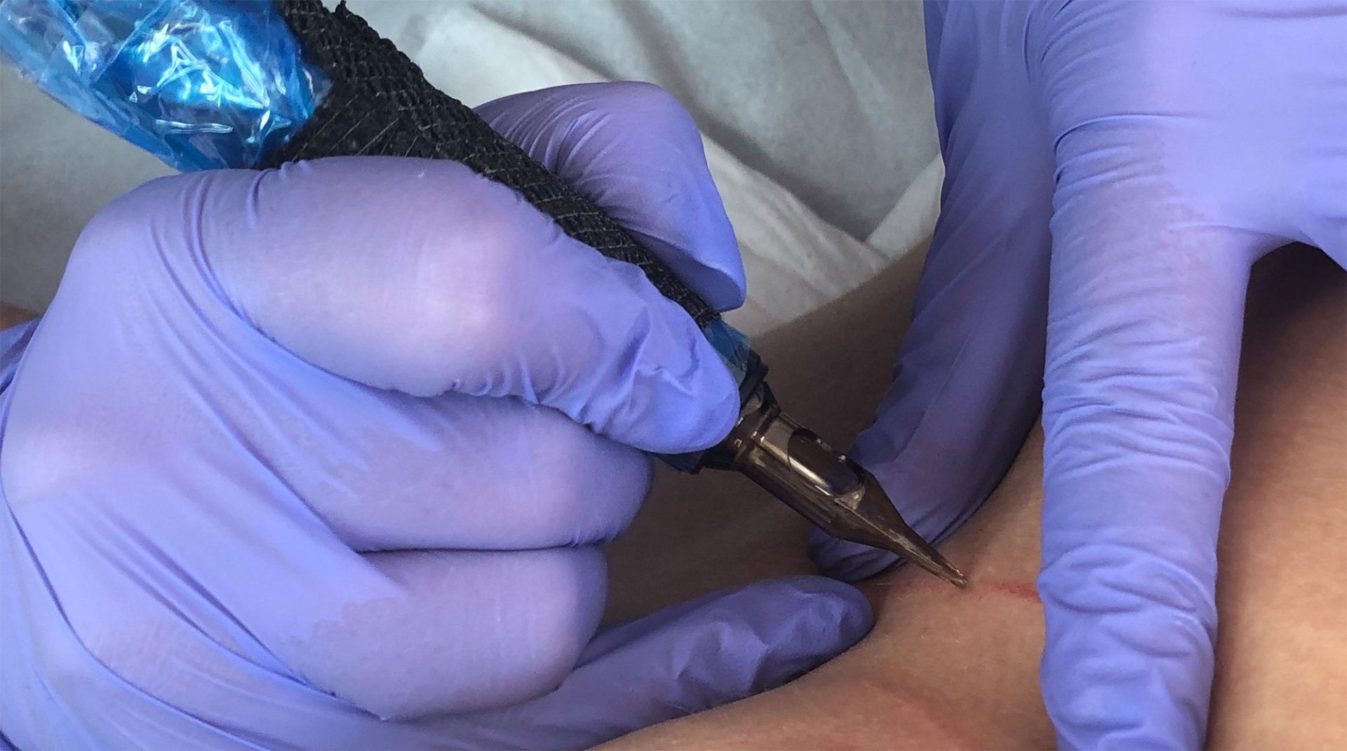 paramedical stretch mark and scar reduction