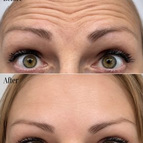 anti wrinkle injections exeter