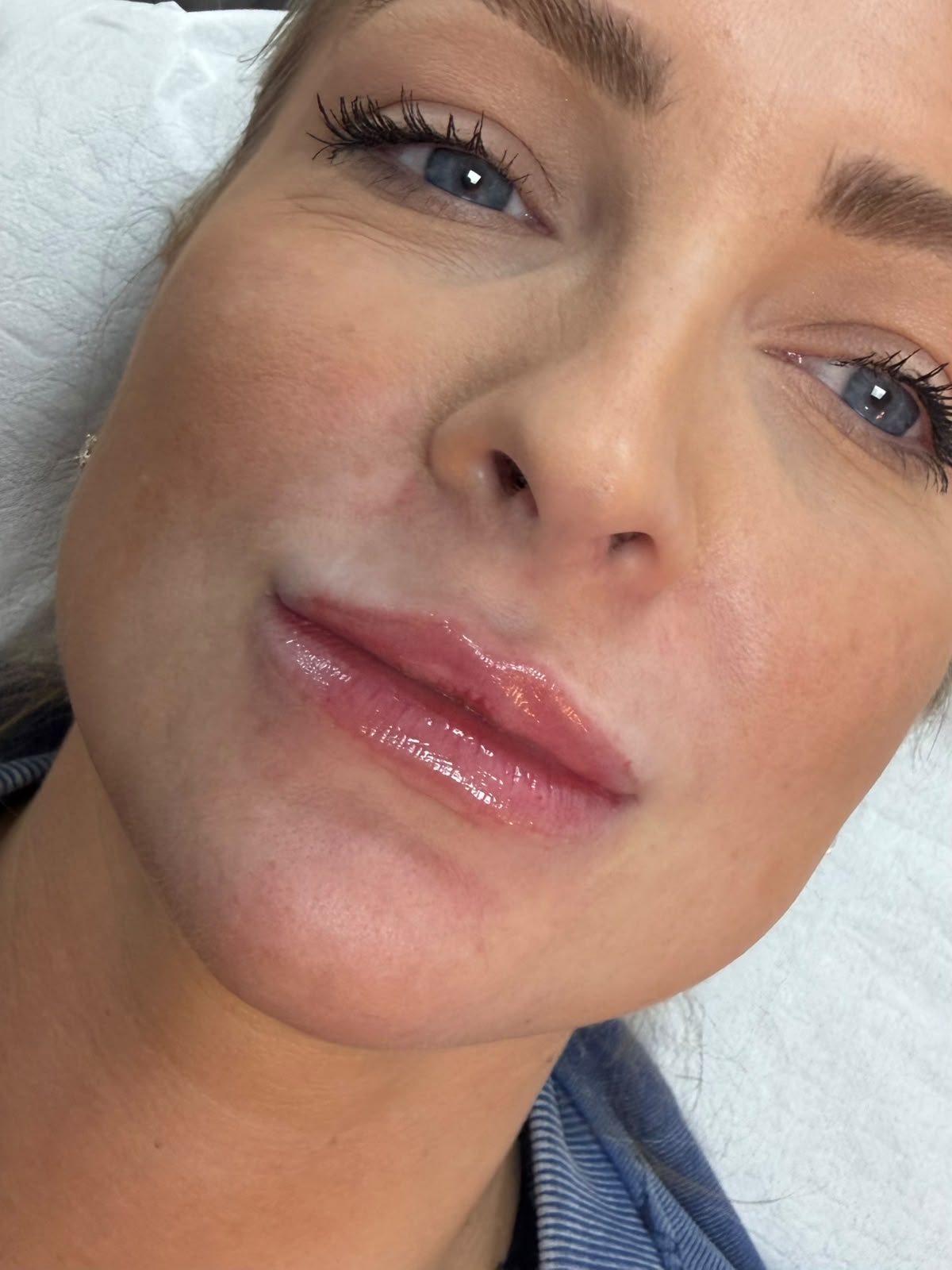natural lip filler exeter
