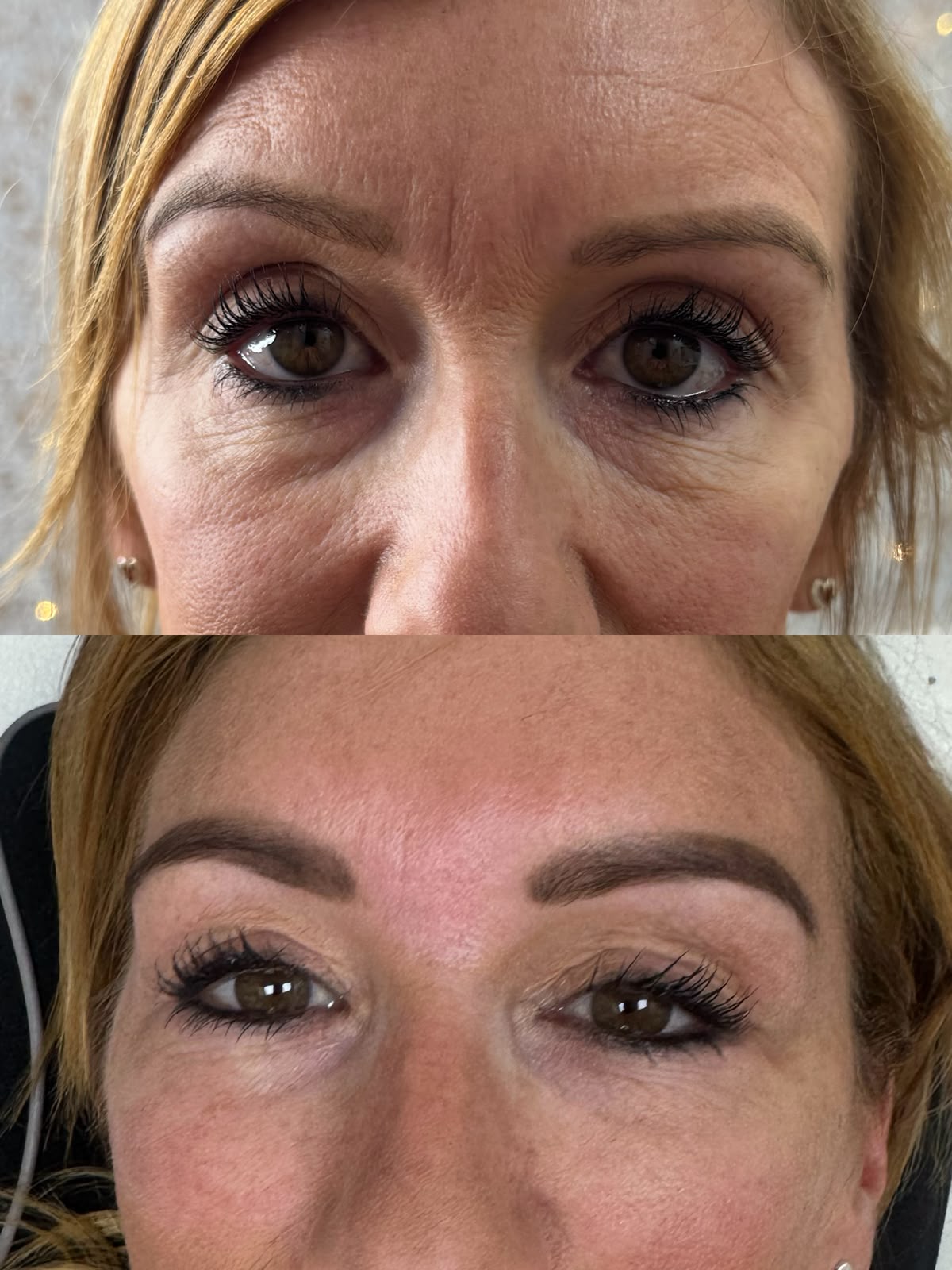 under eye polynucleotides exeter